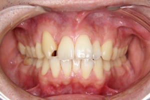 前歯部の叢生、正中のずれ